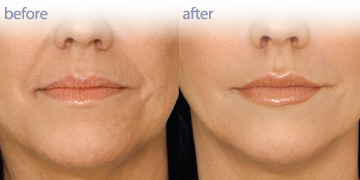 Dermal Fillers Vancouver| PenderMediSpa