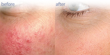 Wrinkle Reduction | Skin Care Clinic Vancouver