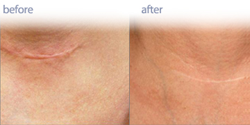 Laser Scar Reduction Vancouver | Pender Medi Spa | Skin Care Clinic