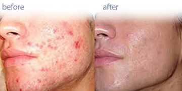 Silkpeel Dermal Infusion Vancouver | Pender Medi Spa