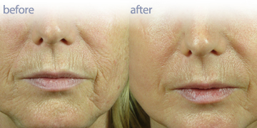 Laser Skin Resurfacing Vancouver | Pender Medi Spa