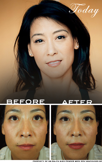 Asian Face Rejuvenation | Before And After | Skin Care Clinic Vancouver