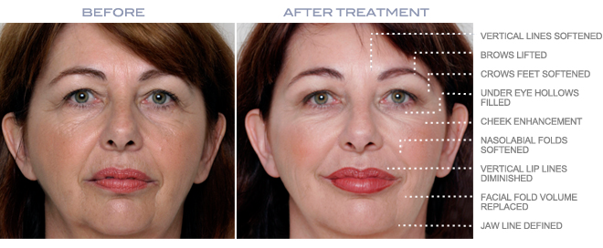 Before and after photo of Juvederm treatment | PenderMediSpa Vancouver