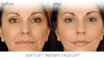 Before and after photo of Soft-Lift non surgical facelift with Juvederm | PenderMediSpa Vancouver