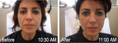 Before-and-After of Non-Surgical Face Lift | Physician Training Centre Before-and-After of Non-Surgical Face Lift | Physician Training Centre
